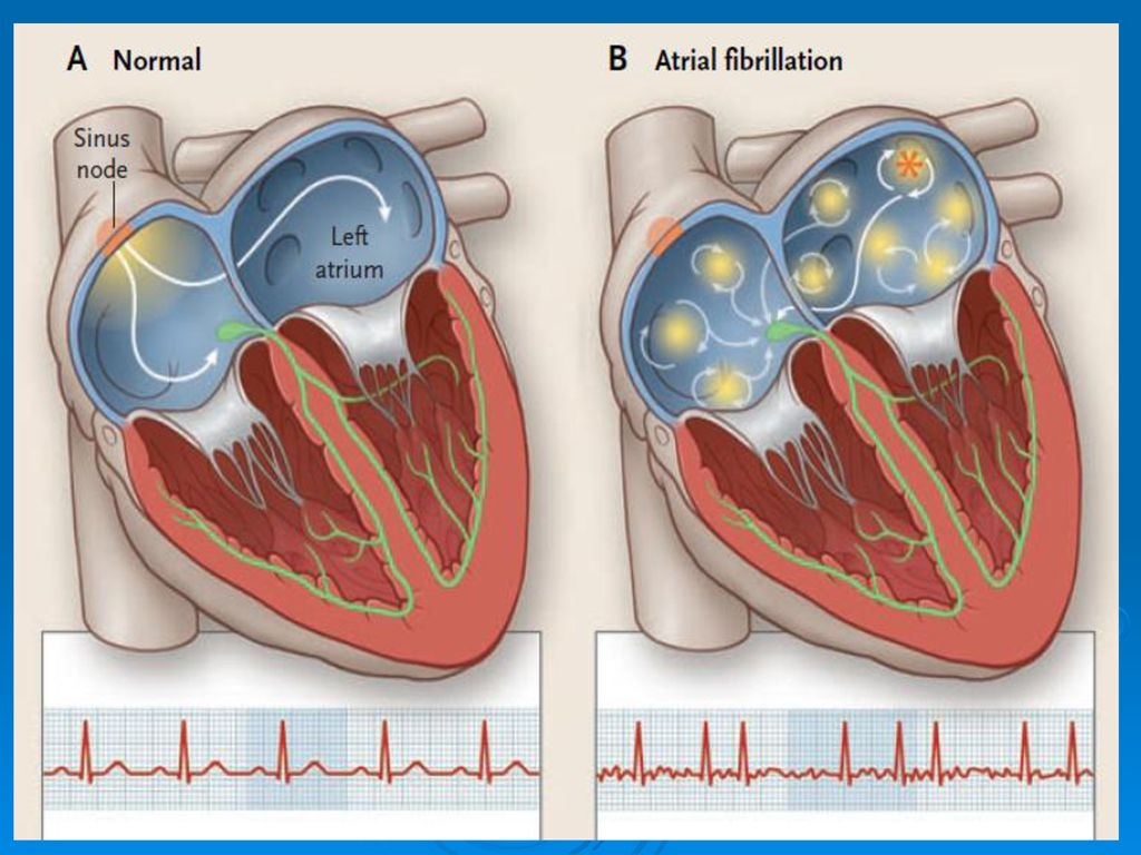 Мерцательная аритмия: без лечения возможны тромбы и проблемы с головным  мозгом | О здоровье: с медицинского на русский | Дзен