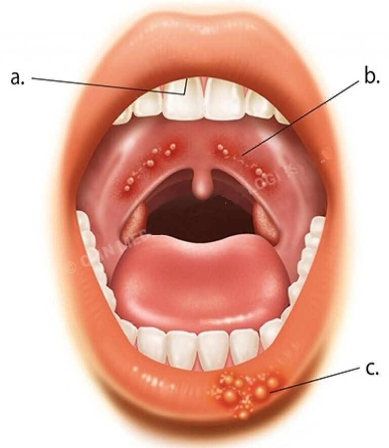 Герпангина у взрослых консультация лечение в клинике