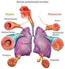 Бронхит - причины, симптомы и лечение острого и хронического бронхита