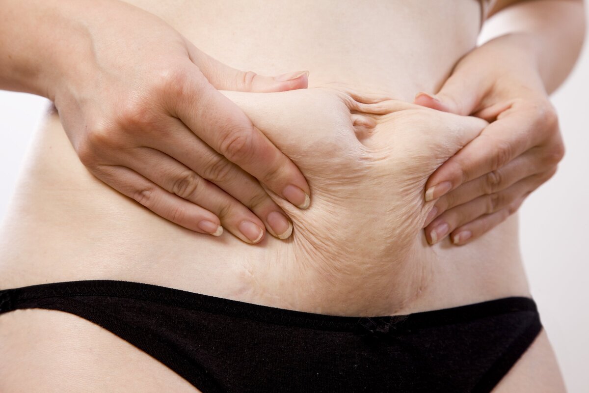 Беременной женщине кесарева. Тело женщины после родов. Тело после кесарева сечения.