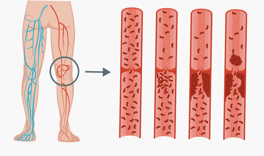 Тромбоз глубоких вен нижних конечностей