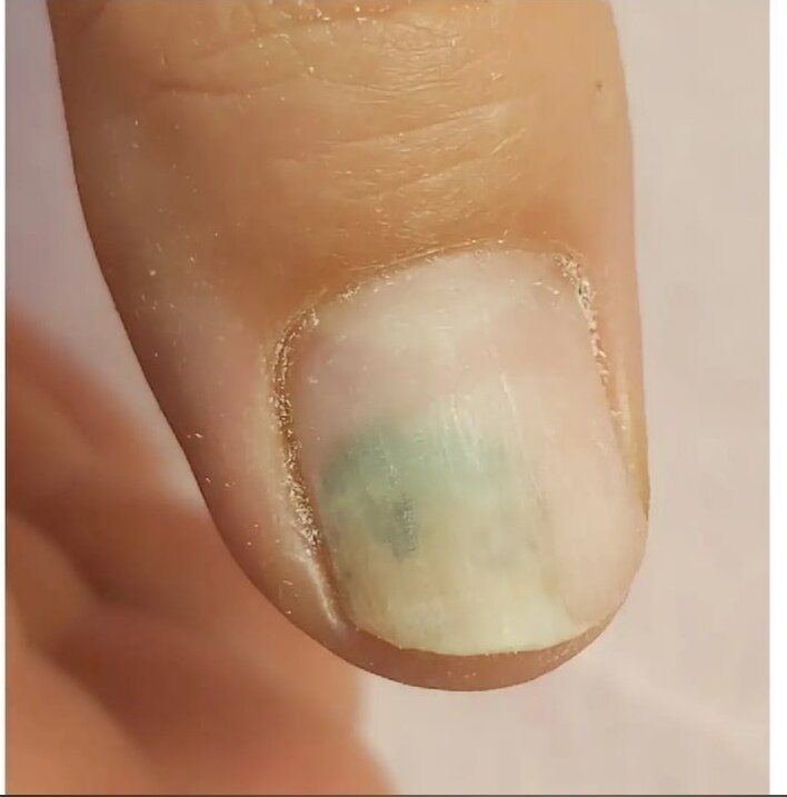                                                                              онихолизис