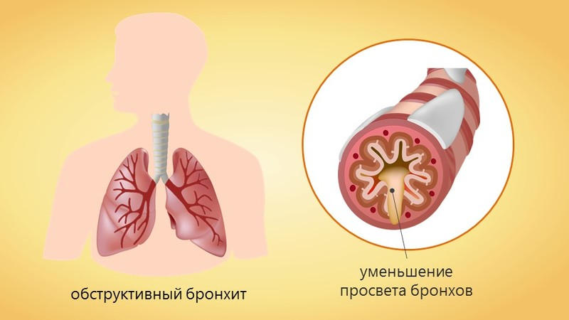 Бронхит - причины, симптомы и лечение острого и хронического бронхита