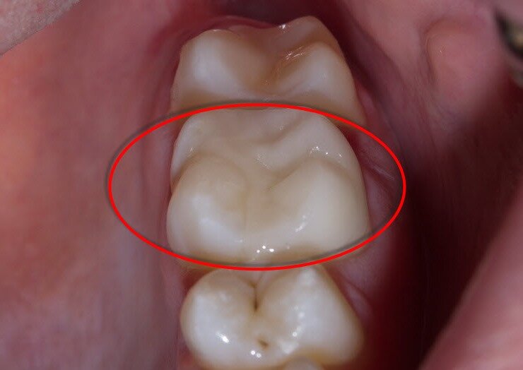 Почему может гнить зуб под коронкой? - Дентум Стоматология