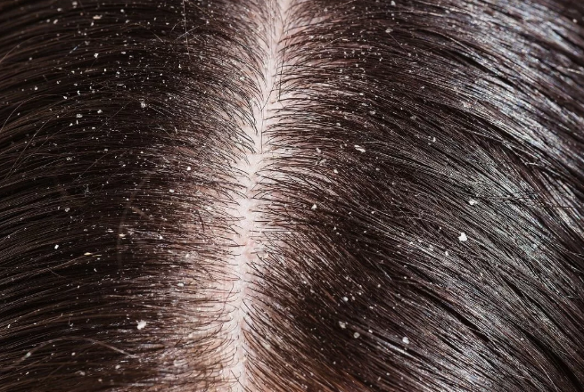 Сухая перхоть