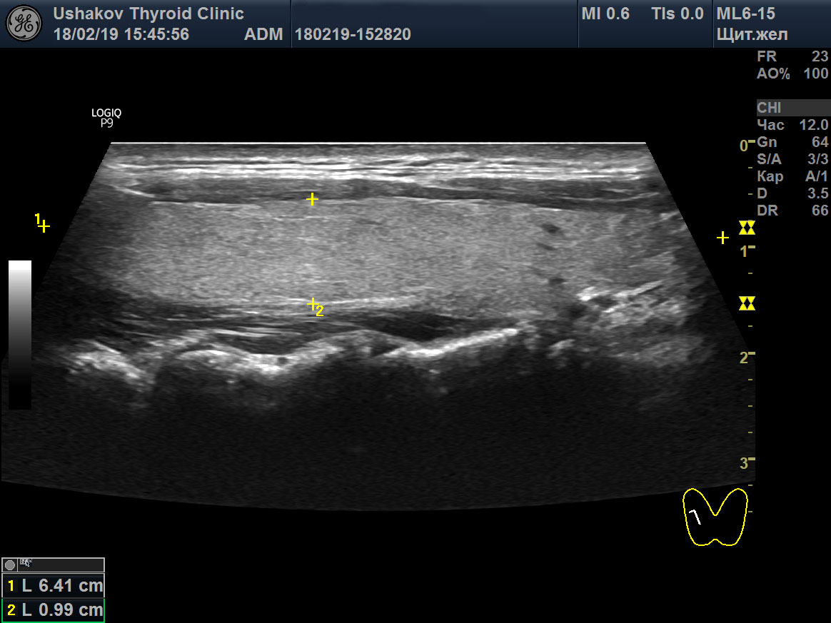 УЗИ. Нормальная ткань щитовидной железы. Почти однородная светло-серая.