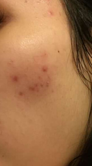 Это уже все начало заживать, было в разы хуже. 