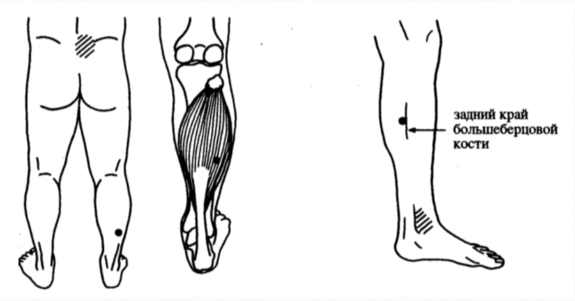 Болит икроножная мышца. Икроножная и камбаловидная мышцы анатомия. Болит камбаловидная мышца на левой ноге. Болит икра правой ноги. Болевые точки на икрах ног.