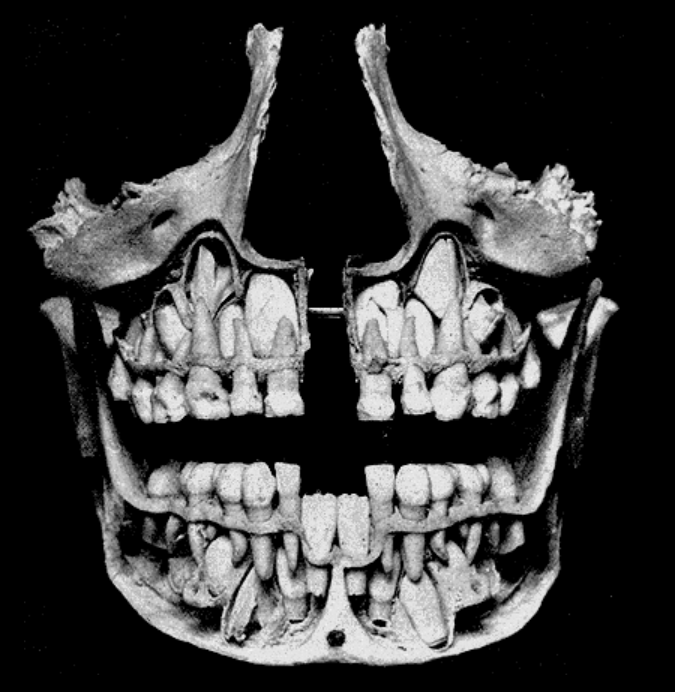 Имплантация зубов при отсутствии костной ткани (атрофии)