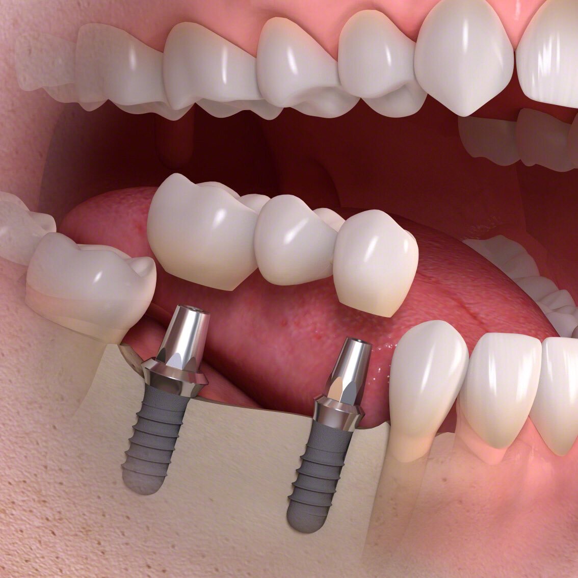 Как выглядят мосты в стоматологии