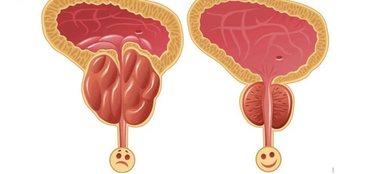 Простата и предстательная железа. Доброкачественная гиперплазия предстательной железы. Лазерная энуклеация простаты. Простата здоровая и воспаленная. Острый бактериальный простатит.