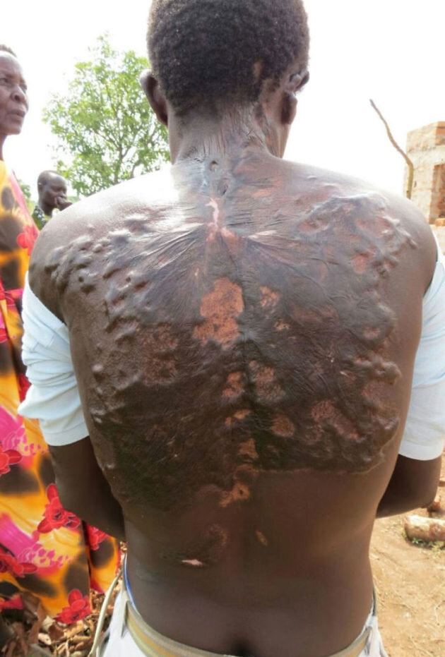 ожог от удара молнии