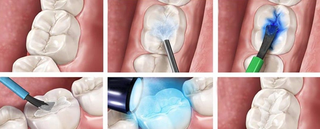 Пломба световой полимеризации. Запечатывание фиссуры зуба герметиком что это. Пломба композита светоотверждаемого. Пломбы фотоотверждаемые композиты.