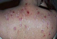 Вид поврежденной кожи