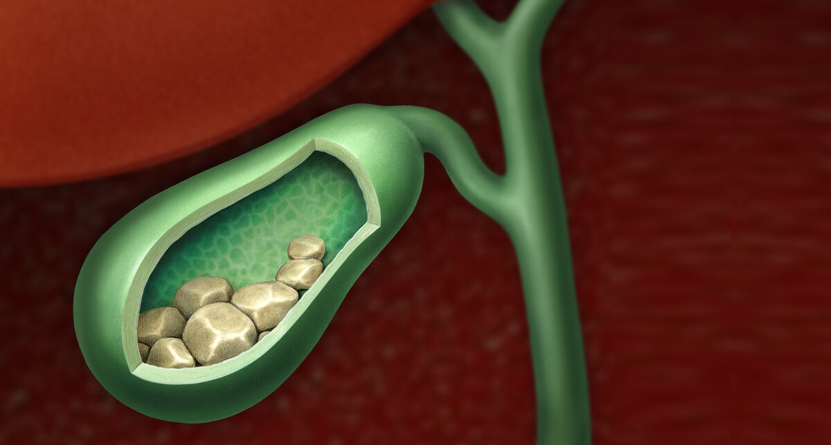 Желчный пузырь с камнями картинка