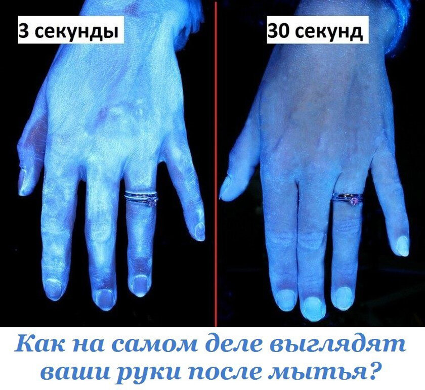 Как выглядит рука после. Поломанная рука без гипса. Как выглядит рука после. Ложный сустав запястья. Деформация лучезапястного сустава.