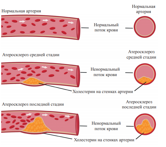 Как проверить сосуды на бляшки. Атеросклероз строение бляшки. Строение атеросклеротической бляшки. Структура атеросклеротической бляшки. Стадии формирования атеросклеротической бляшки.