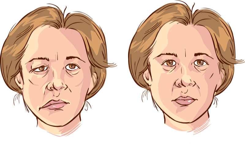 Паралич Белла или иначе называемый идиопатическим периферическим параличом лицевого нерва чаще всего является причиной одностороннего поражения нервных волокон в тканях лица.