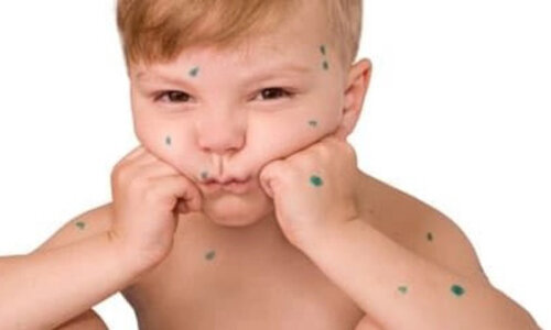 Ветряная оспа (varicella, chickenpox) — острое инфекционное заболевание, сопровождающееся лихорадкой и пузырьковой сыпью. Заболевание вызывается вирусом Варицелла-Зостер (Varicella-Zoster). У взрослых Варицелла-Зостер вызывает опоясывающий лишай. Несмотря на то, что описание инфекции сделано еще в античные времена, а инфекционная природа заболевания доказана еще в 1875 г., сам вирус был выделен лишь в 1958 г. Вирус ветряной оспы поражает только человека. 