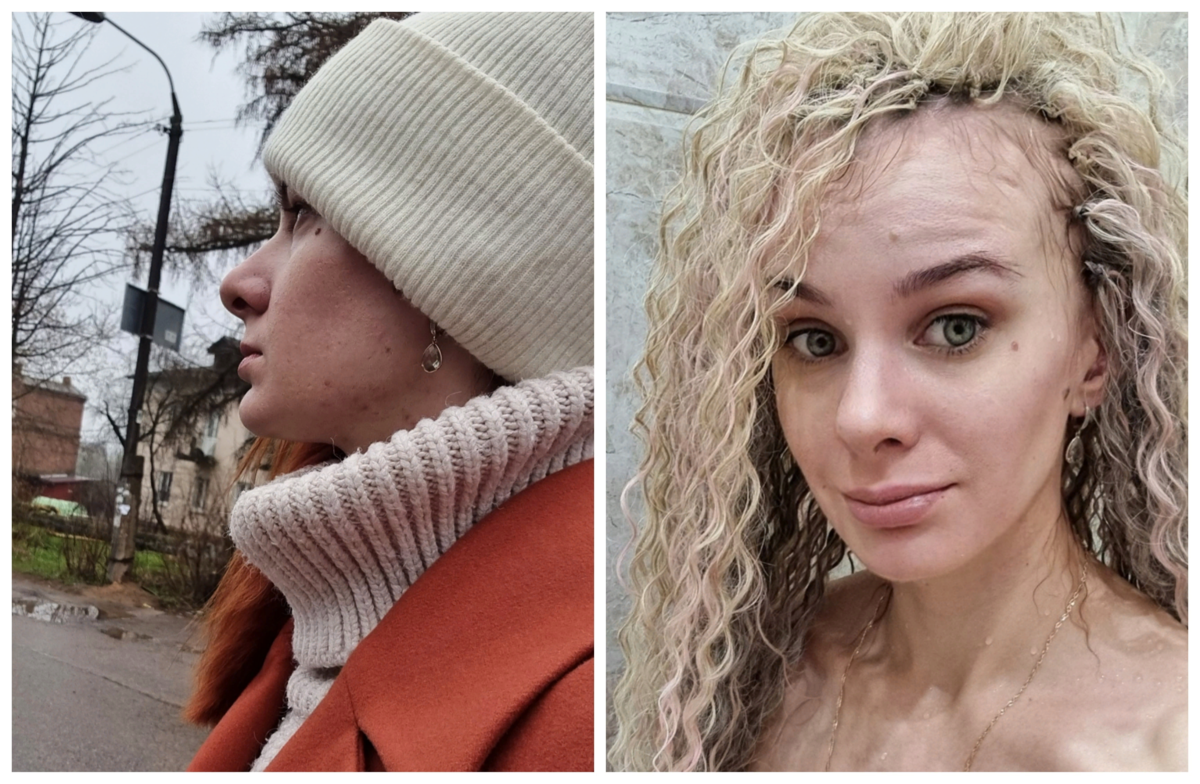 Раньше мне приходилось щедро пользоваться корректорами и скрывать шею под воротниками, сейчас же кожа абсолютно чистая и ровная