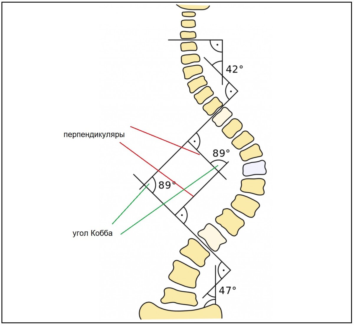 Что такое угол Кобба | Сколио центр | Дзен
