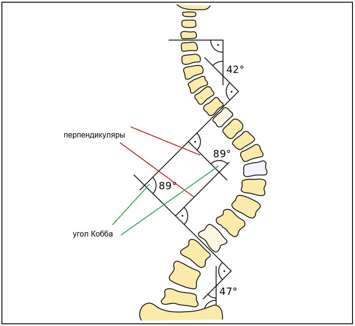 Угол кобба. Угол Кобба степени сколиоза. Угол сколиоза по методу Кобба. Угол Кобба позвоночника кифоз. Метод Кобба сколиоз степени.