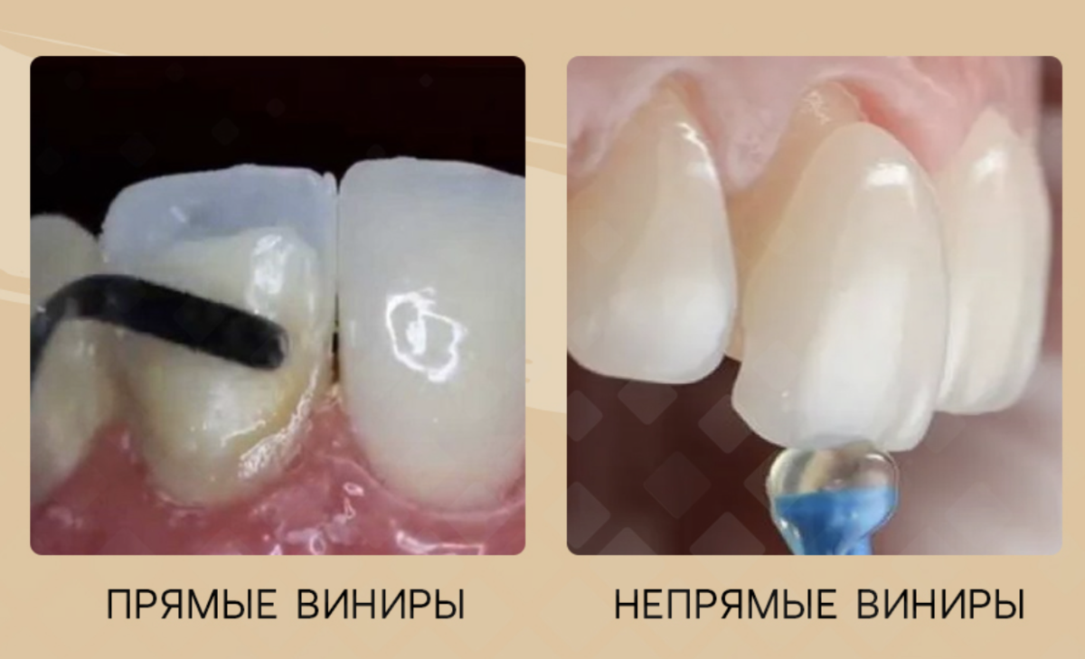 Виниры можно смоделировать прямо на зубе или изготовить их отдельно, а приклеить потом. Фотоколлаж: Smile-at-Once.ru. 