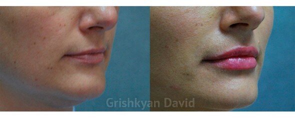 Липофилинг губ фото до и после. Фото с сайта Д.Р. Гришкяна. Имеются противопоказания, требуется консультация специалиста