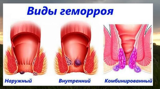 Наружный геморрой: причины, диагностика и лечение