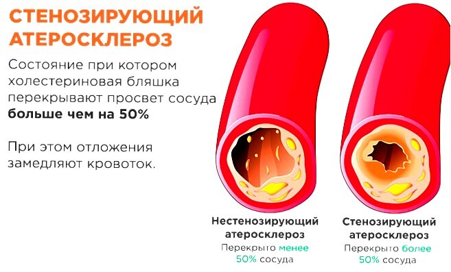 Холестериновые бляшки они навсегда? Воспользуйтесь 8 советами, для ...