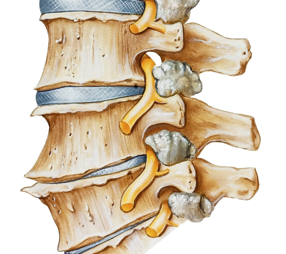 Виды спондилеза