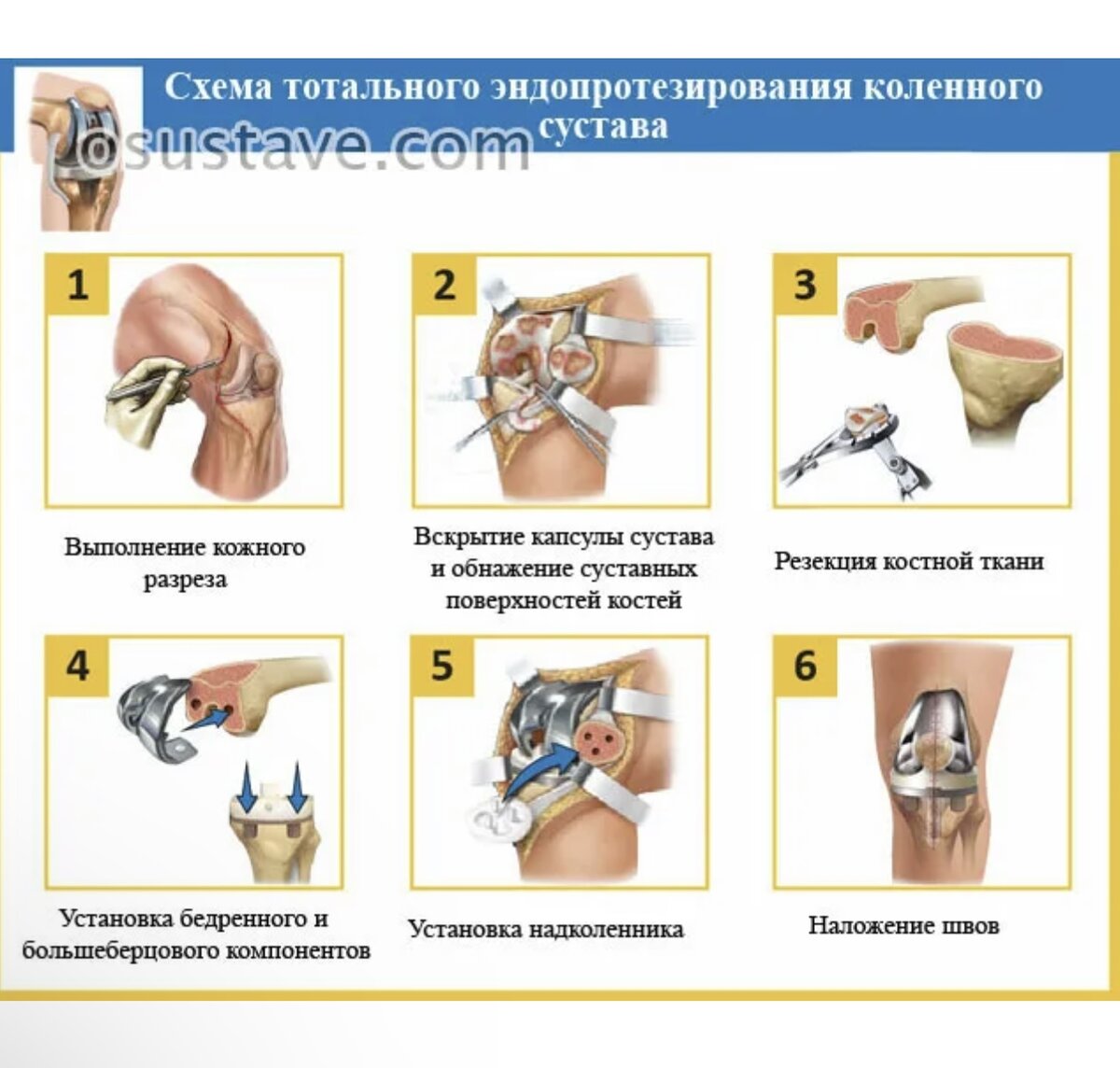 Замена коленного сустава картинка