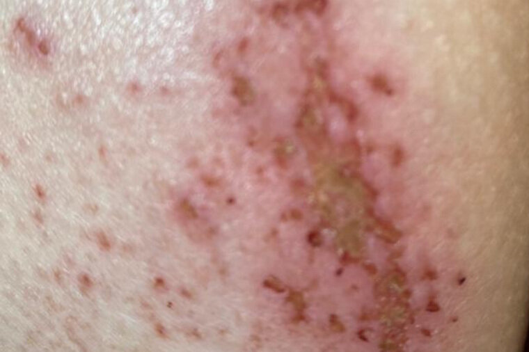    Такой след остался на одной ягодице тюменки читатель URA.RU