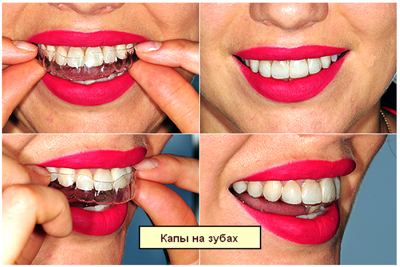 Съемные ретейнеры легко надеваются, но все же заметны на зубах 