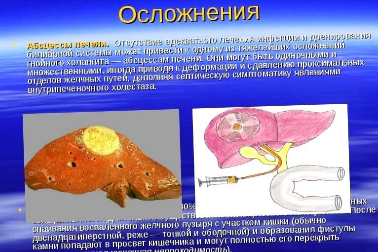 Абсцесс печени картинки