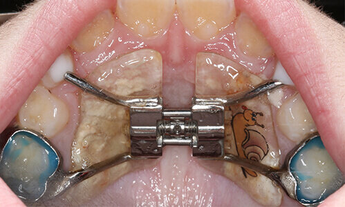 Аппарат Марко Роcа