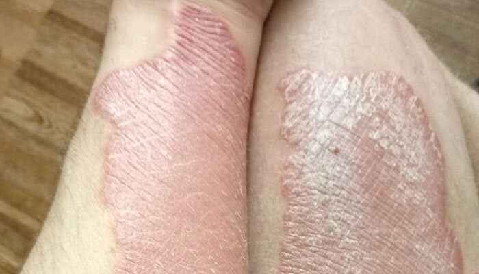 Псориаз на ногах