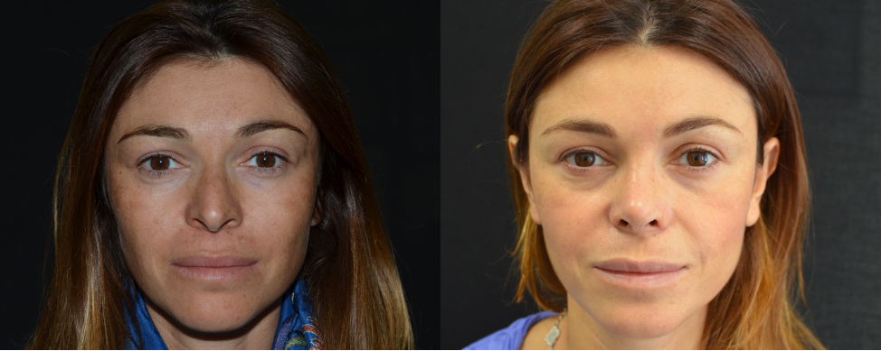 Фото до и после ринопластики с сайта хирурга Д.Р. Гришкяна, имеются противопоказания, требуется консультация специалиста. 