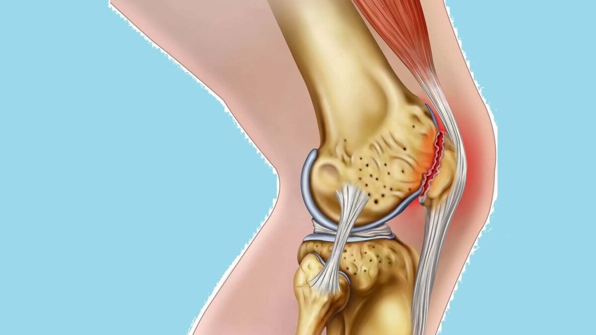 Болит надколенник. Внутренний менисцит коленного сустава.