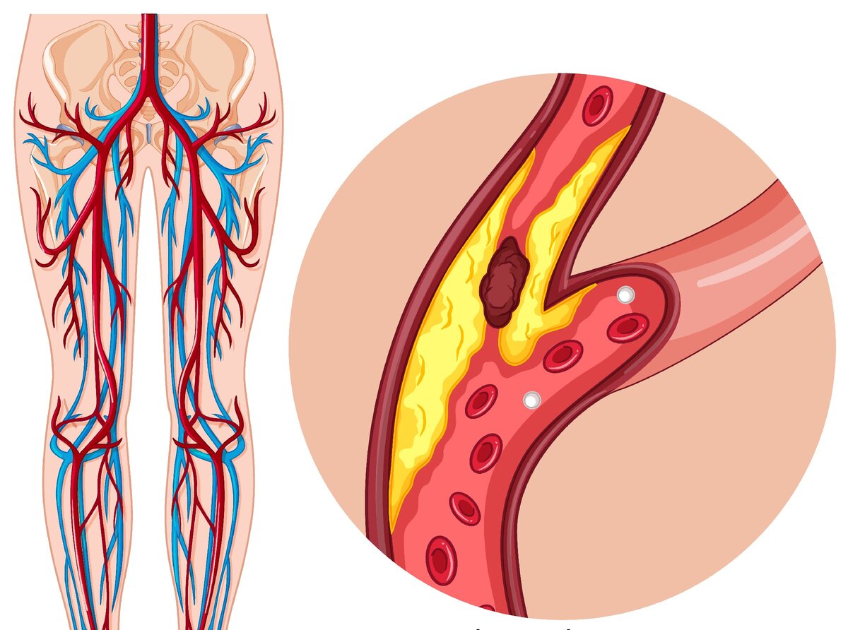 Атеросклероз артерий нижних конечностей - это хроническое заболевание с изменением сосудистой стенки в виде образования атеросклеротической бляшки.