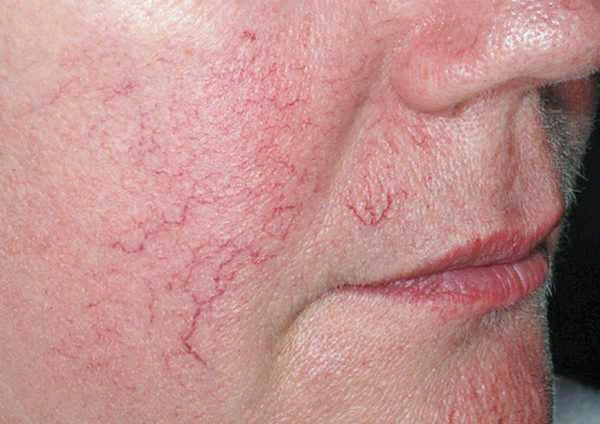 Сосудистые звездочки на лице.