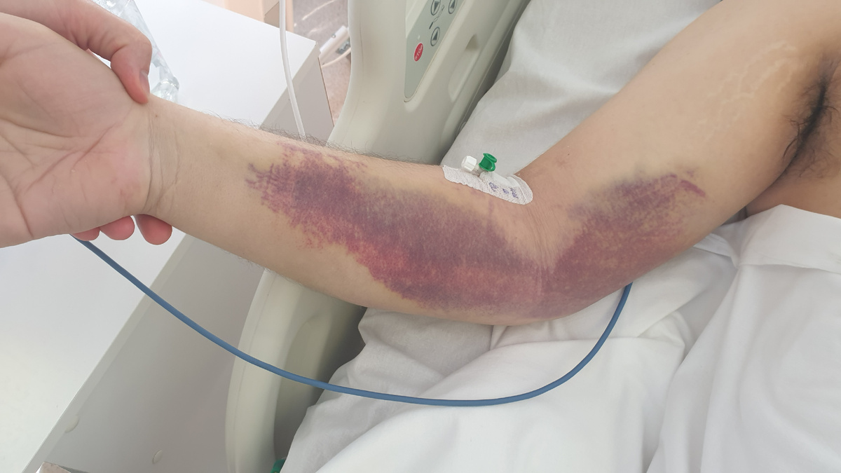 Гематомы на руке от ударов палками