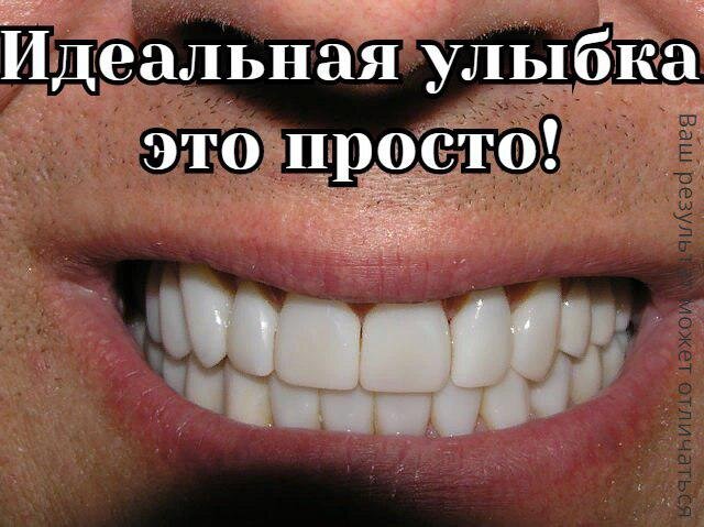 Съемные виниры