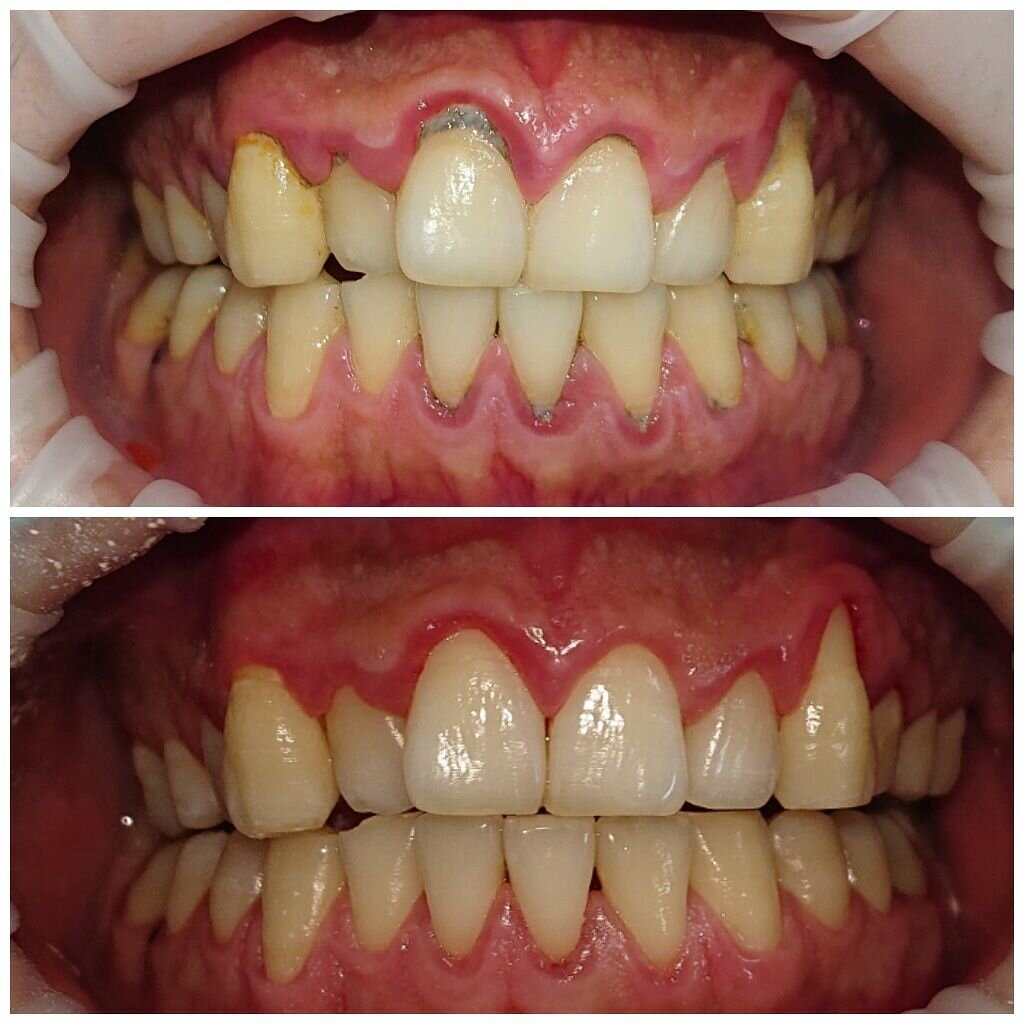 До и после. Профессиональная гигиена полости рта. Поддесневые зубные  отложения и рецессия десен. | Советы стоматолога | Дзен