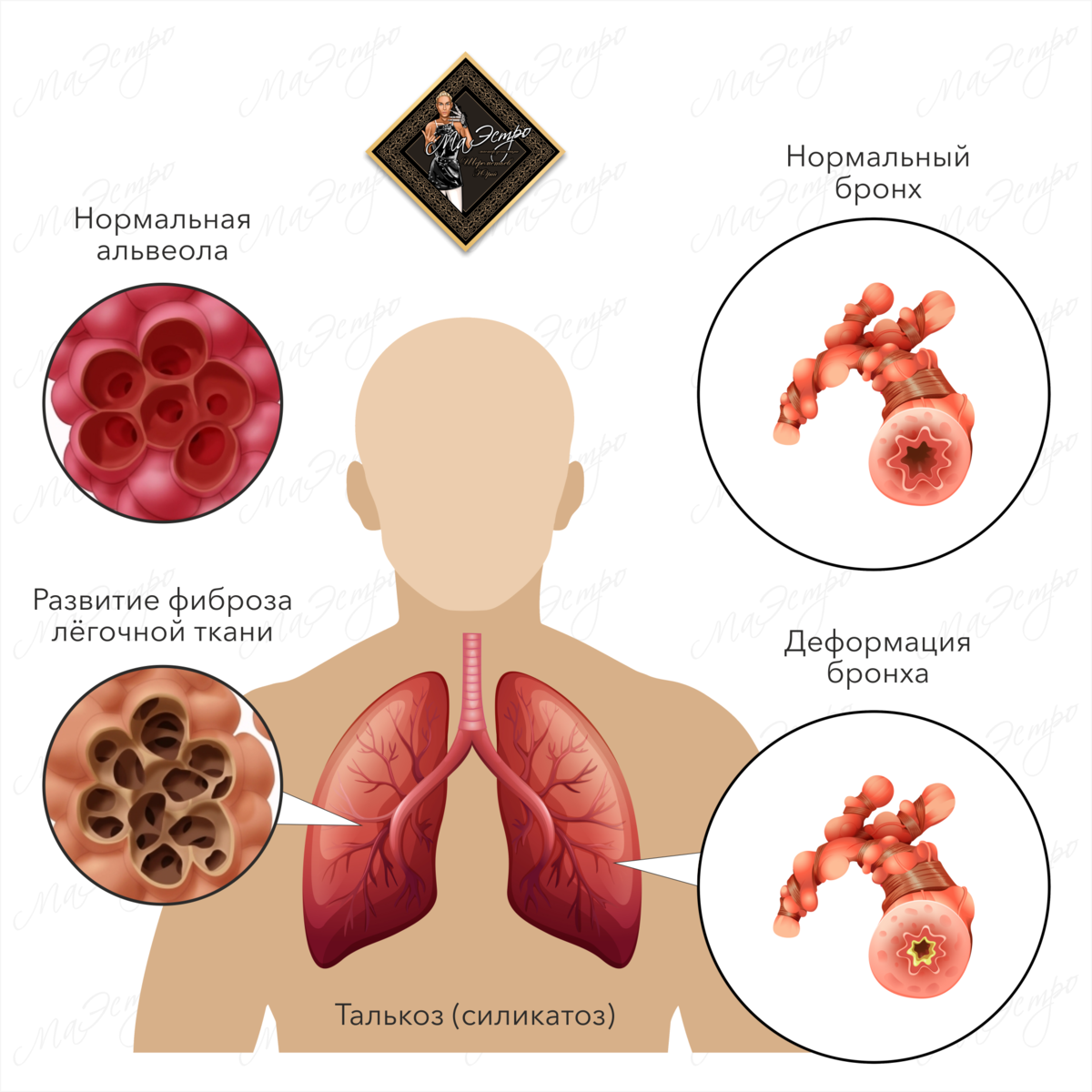 Талькоз силикатоз