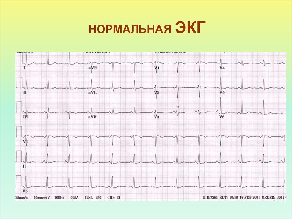 ЭКГ в норме