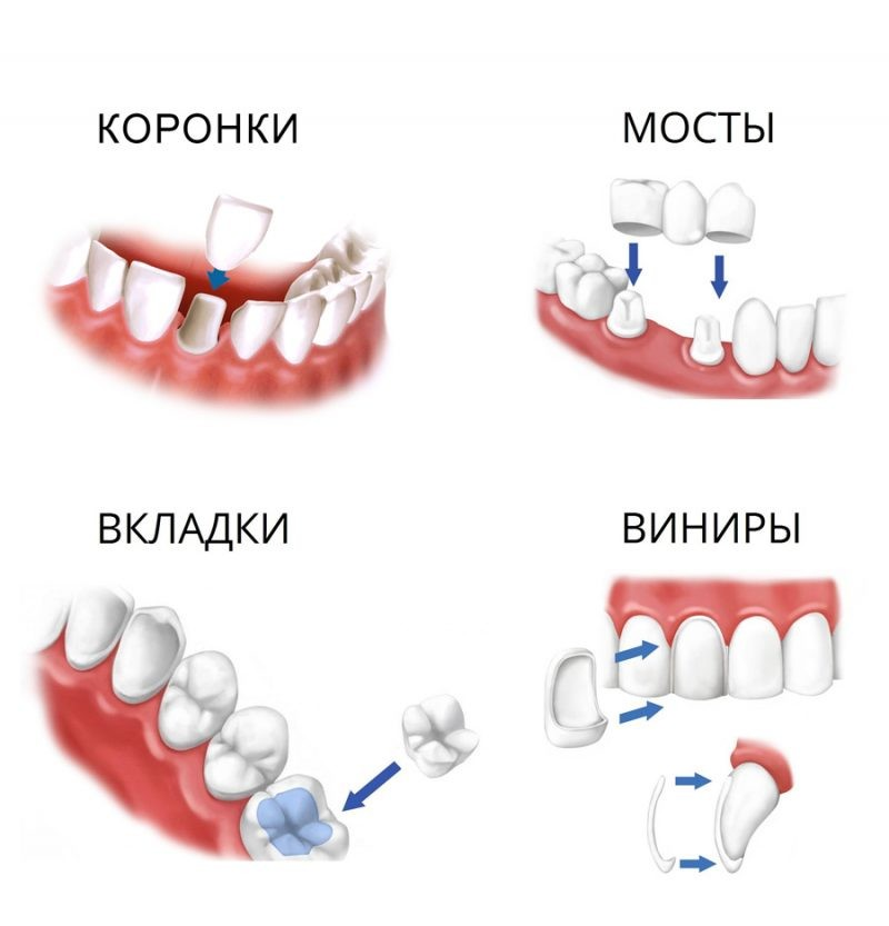 Стоматология мост что это такое