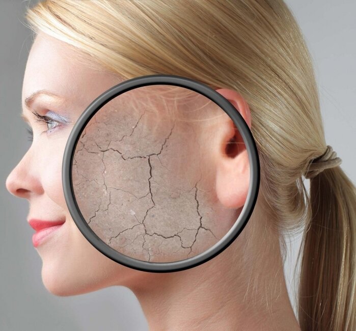 Обезвоженная кожа: шелушится, ее стягивает после умывания, могут быть расширенные поры и локальные проблемы на лице.