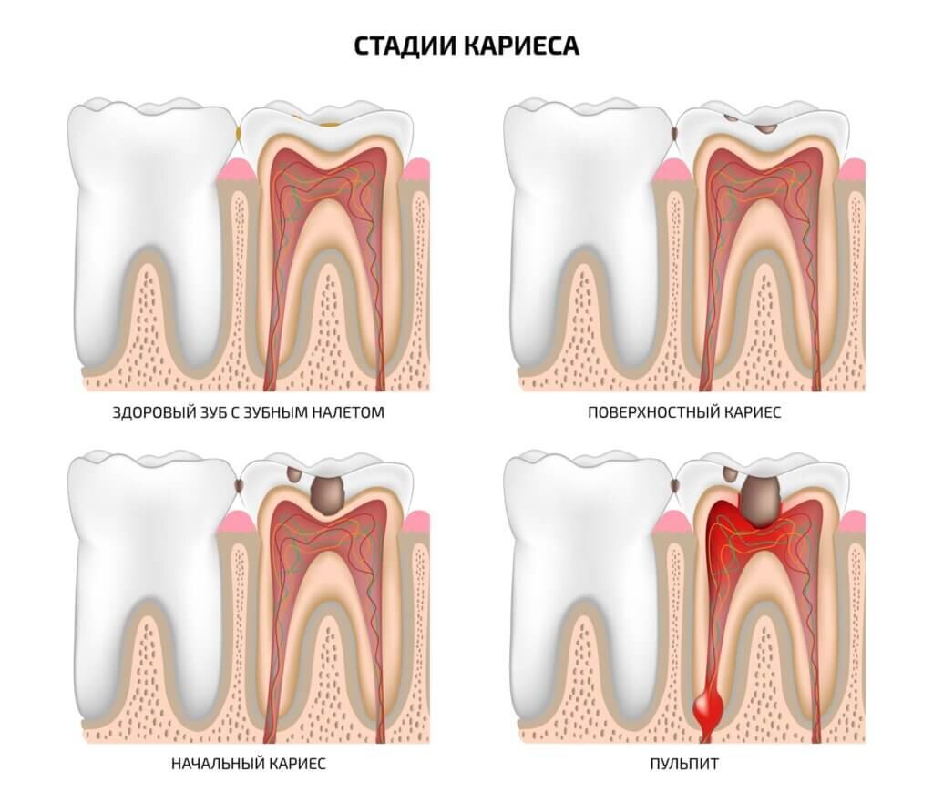 Стадии образования кариеса