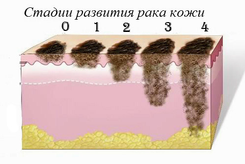 стадии развития рака кожи